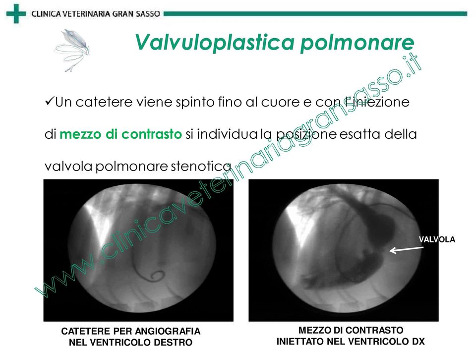 esatta della valvola polmonare stenotica VALVOLA CATETERE PER