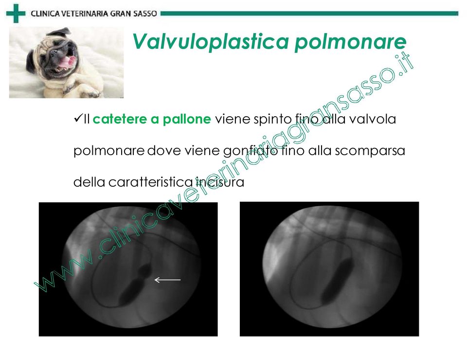 polmonare dove viene gonfiato fino alla