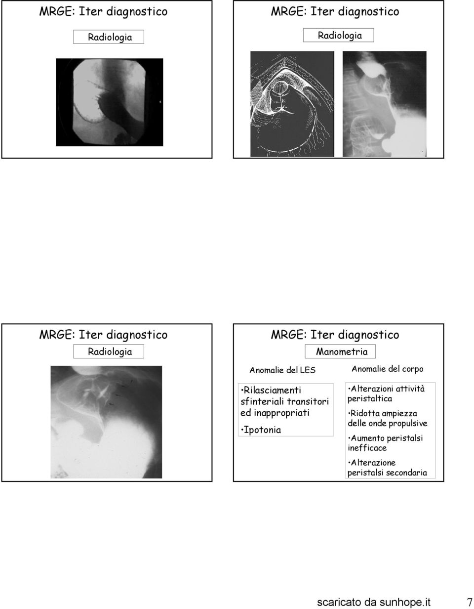 Anomalie del corpo Alterazioni attività peristaltica Ridotta ampiezza