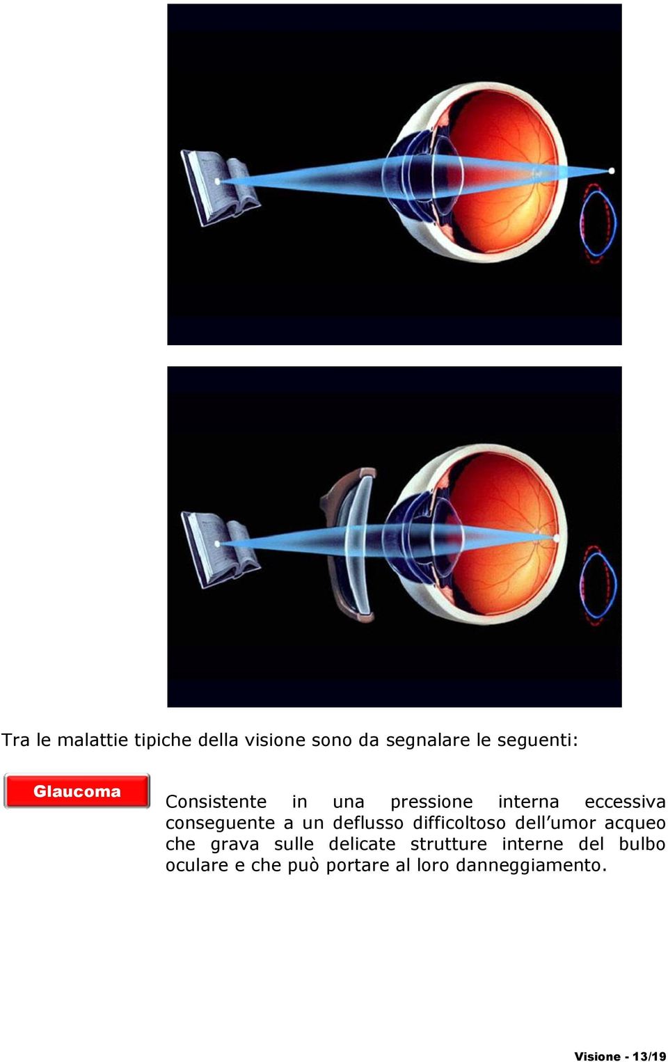 deflusso difficoltoso dell umor acqueo che grava sulle delicate strutture