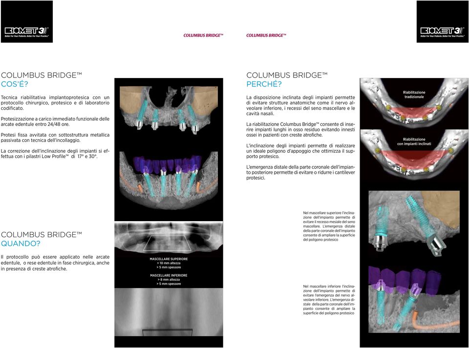 La disposizione inclinata degli impianti permette di evitare strutture anatomiche come il nervo alveolare inferiore, i recessi del seno mascellare e le cavità nasali.