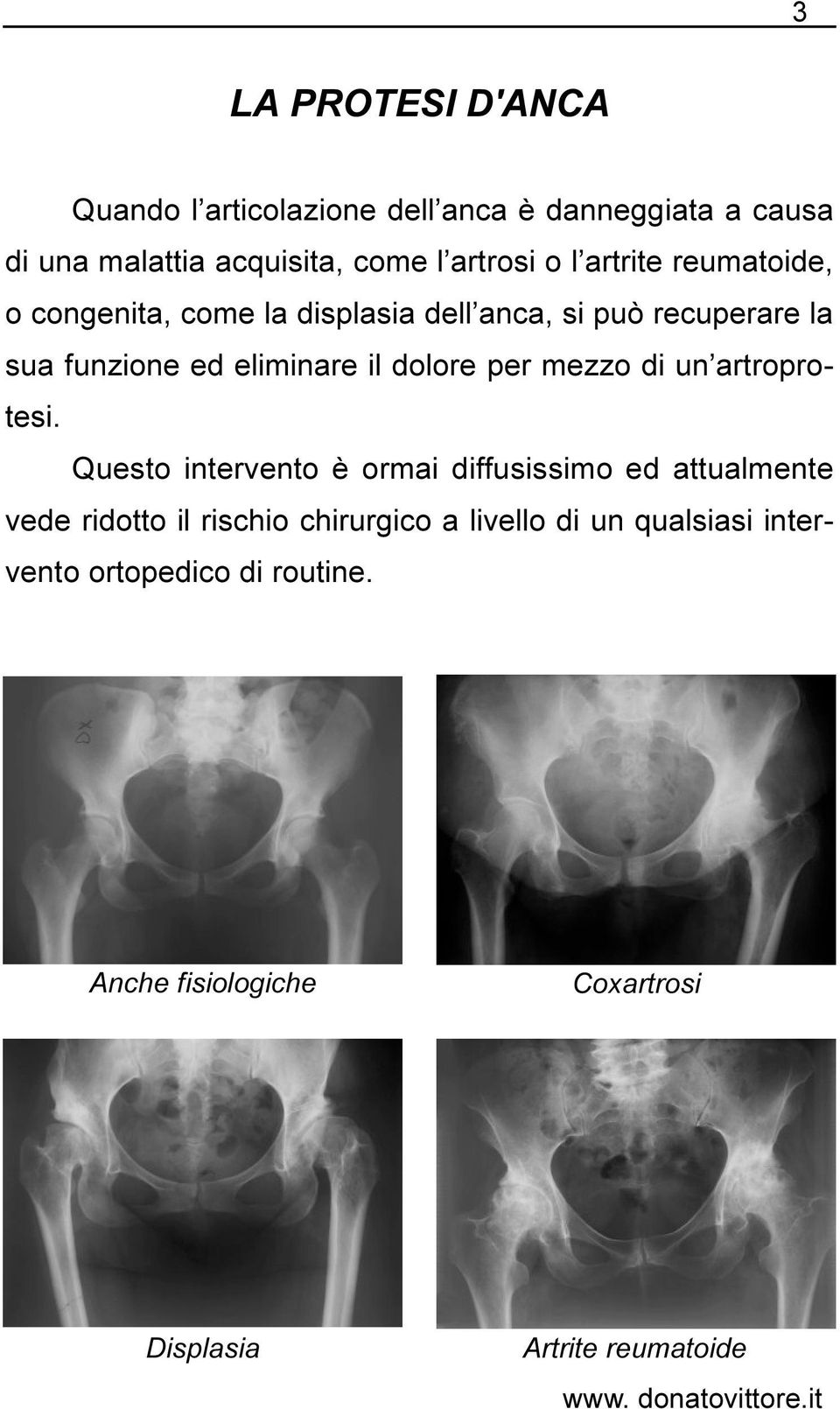 dolore per mezzo di un artroprotesi.