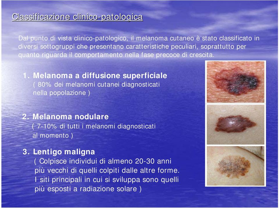 Melanoma a diffusione superficiale ( 80% dei melanomi cutanei diagnosticati nella popolazione ) 2.