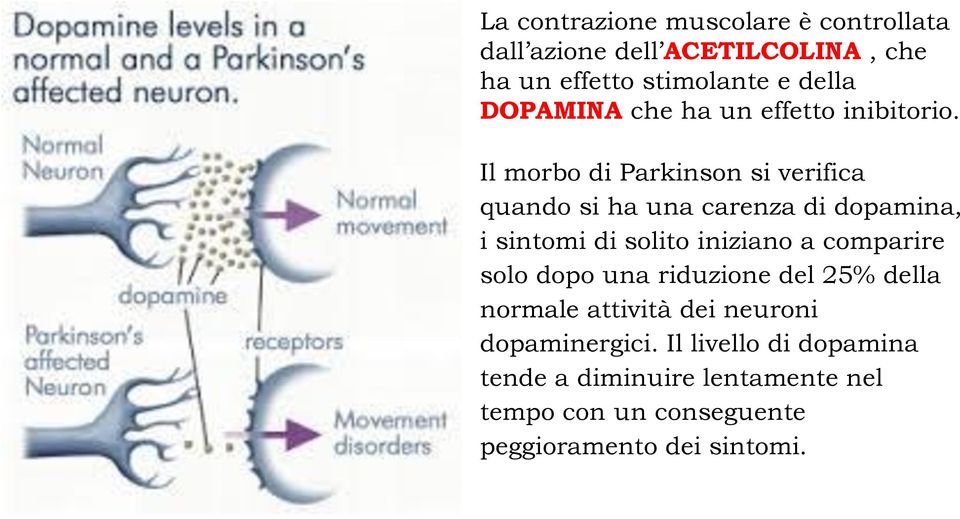 Il morbo di Parkinson si verifica quando si ha una carenza di dopamina, i sintomi di solito iniziano a