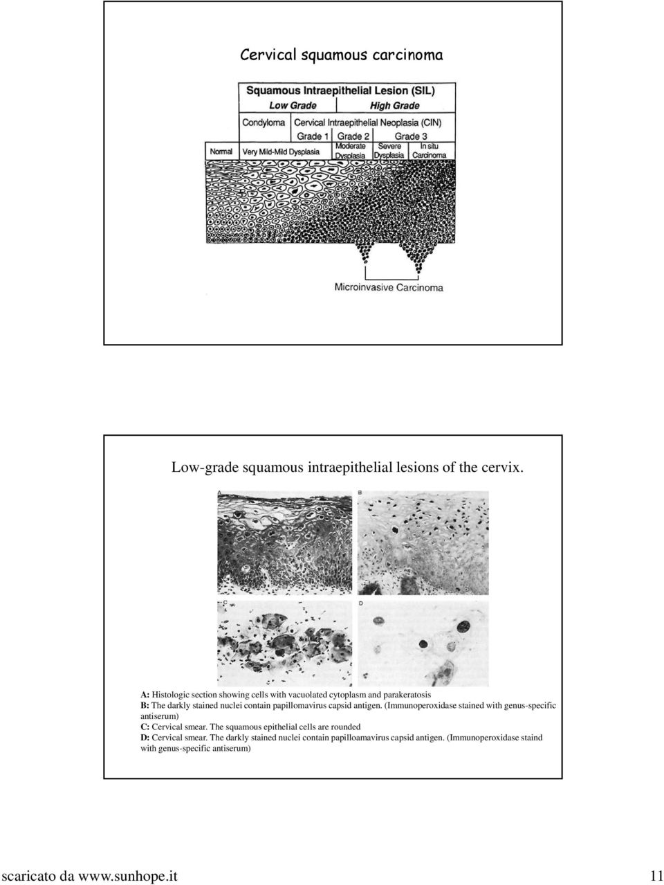 papillomavirus capsid antigen. (Immunoperoxidase stained with genus-specific antiserum) C: Cervical smear.