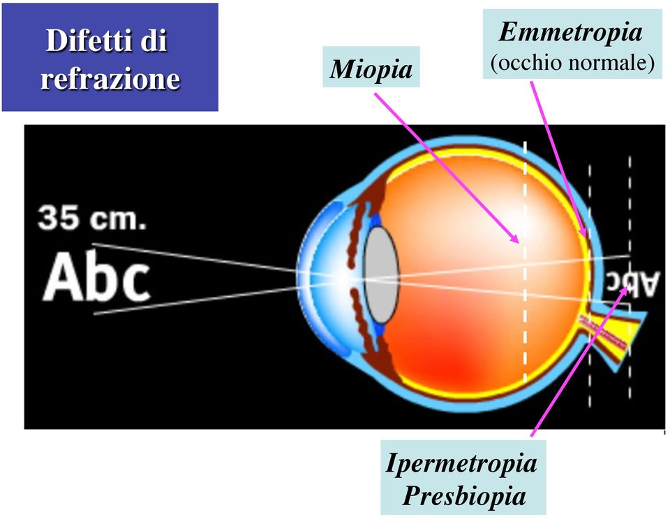 Emmetropia (occhio