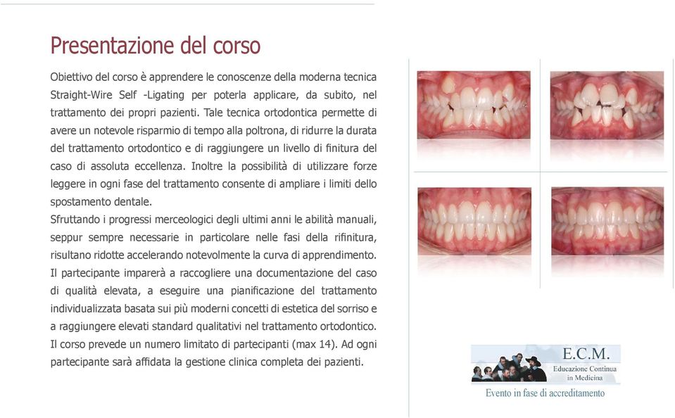 eccellenza. Inoltre la possibilità di utilizzare forze leggere in ogni fase del trattamento consente di ampliare i limiti dello spostamento dentale.