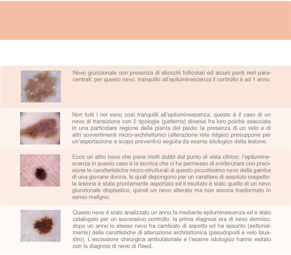 Non tutti i nei sono così tranquilli all epiluminescenza: questo è il caso di un nevo di transizione con 2 tipologie (patterns) diverse fra loro poichè associate in una particolare regione della