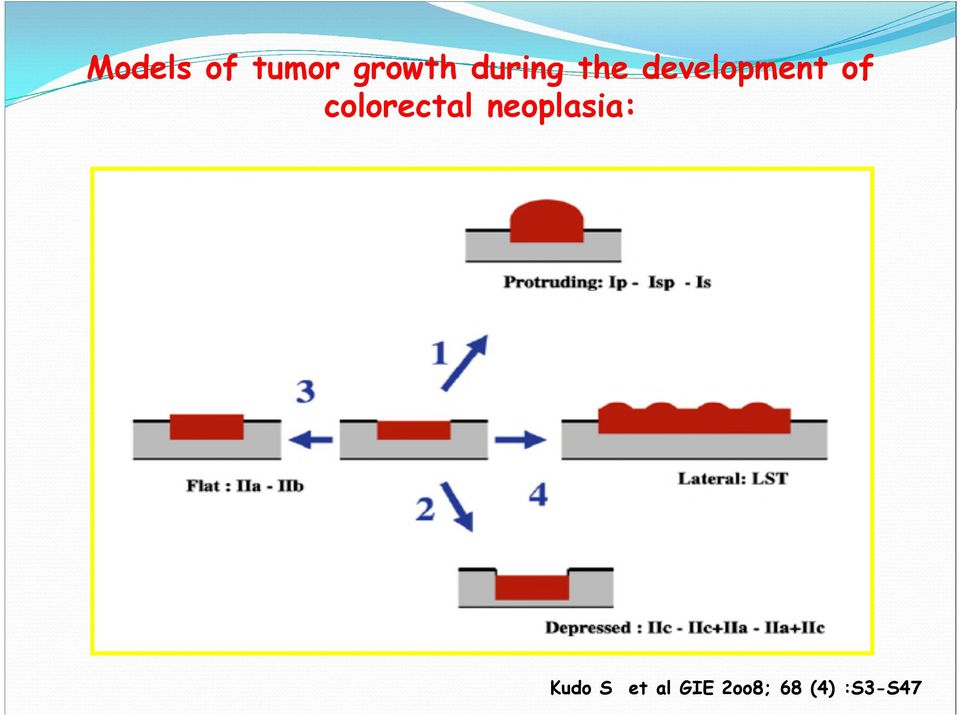 colorectal neoplasia: Kudo