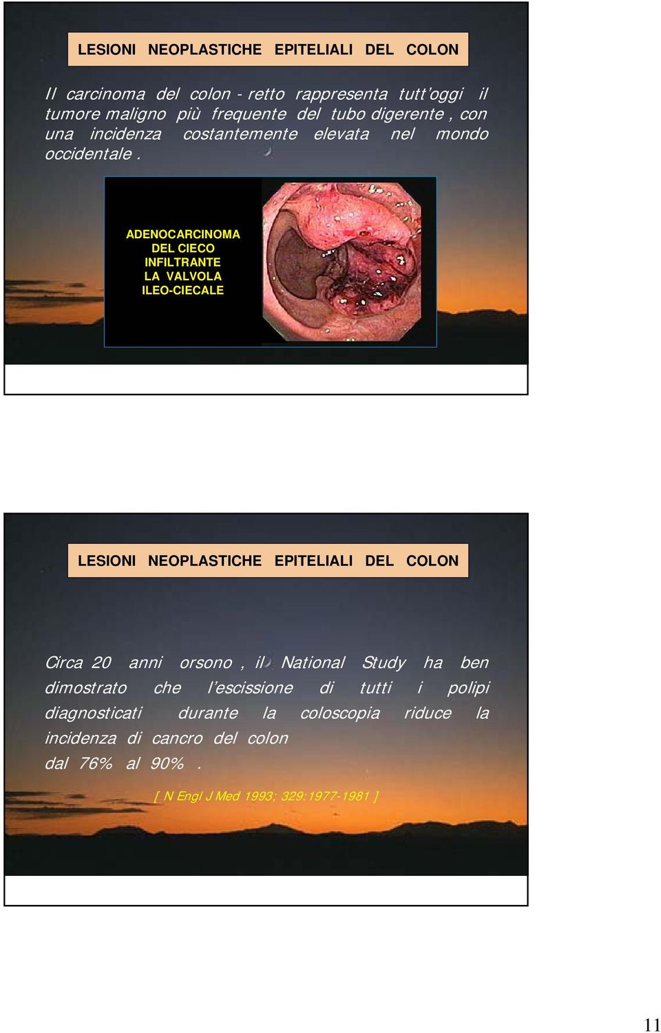 ADENOCARCINOMA DEL CIECO INFILTRANTE LA VALVOLA ILEO-CIECALE LESIONI NEOPLASTICHE EPITELIALI DEL COLON Circa 20 anni orsono, il