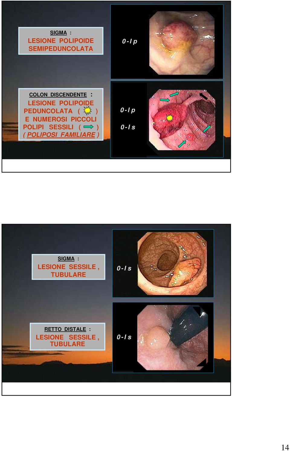 SESSILI ( ) ( POLIPOSI FAMILIARE ) 0-Ip 0-Is SIGMA : LESIONE