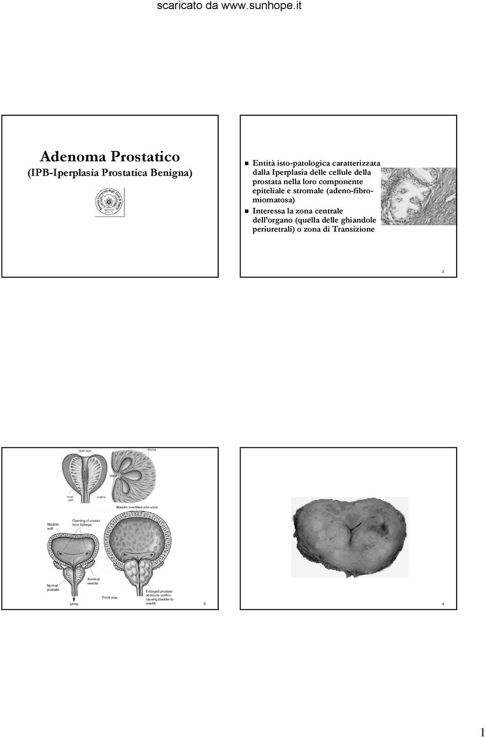 componente epiteliale e stromale (adeno-fibromiomatosa) Interessa la zona