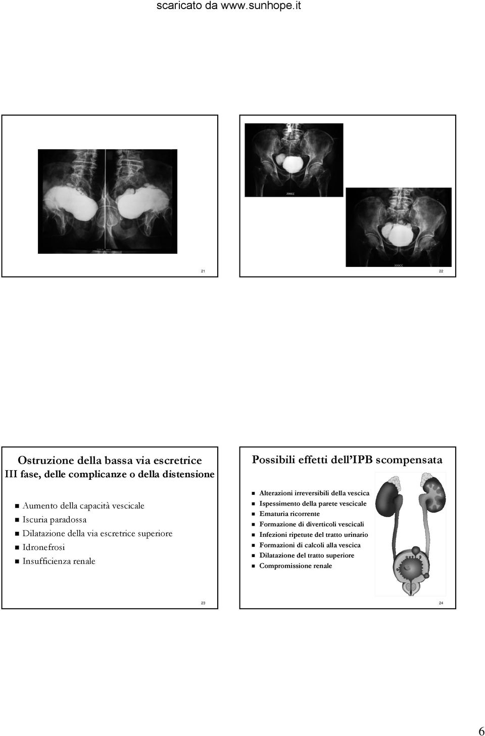 scompensata Alterazioni irreversibili della vescica Ispessimento della parete vescicale Ematuria ricorrente Formazione di