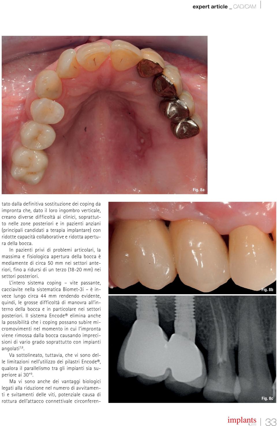 In pazienti privi di problemi articolari, la massima e fisiologica apertura della bocca è mediamente di circa 50 mm nei settori anteriori, fino a ridursi di un terzo (18-20 mm) nei settori posteriori.