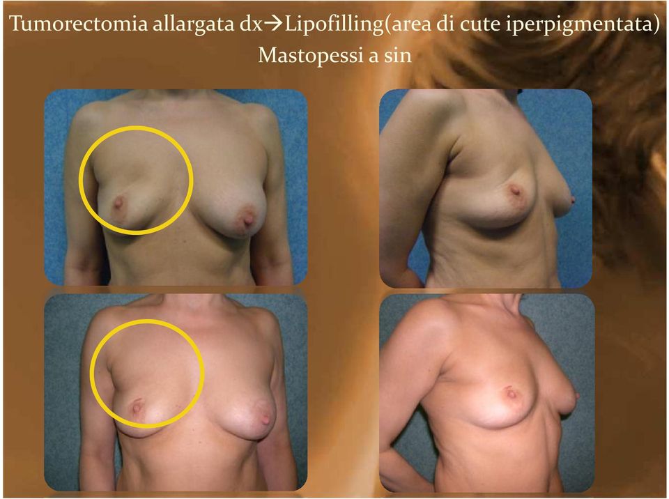 Lipofilling(area di