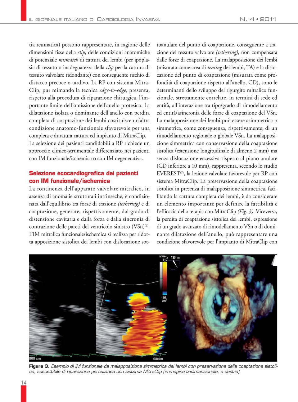 La RP con sistema Mitra- Clip, pur mimando la tecnica edge-to-edge, presenta, rispetto alla procedura di riparazione chirurgica, l im - portante limite dell omissione dell anello protesico.