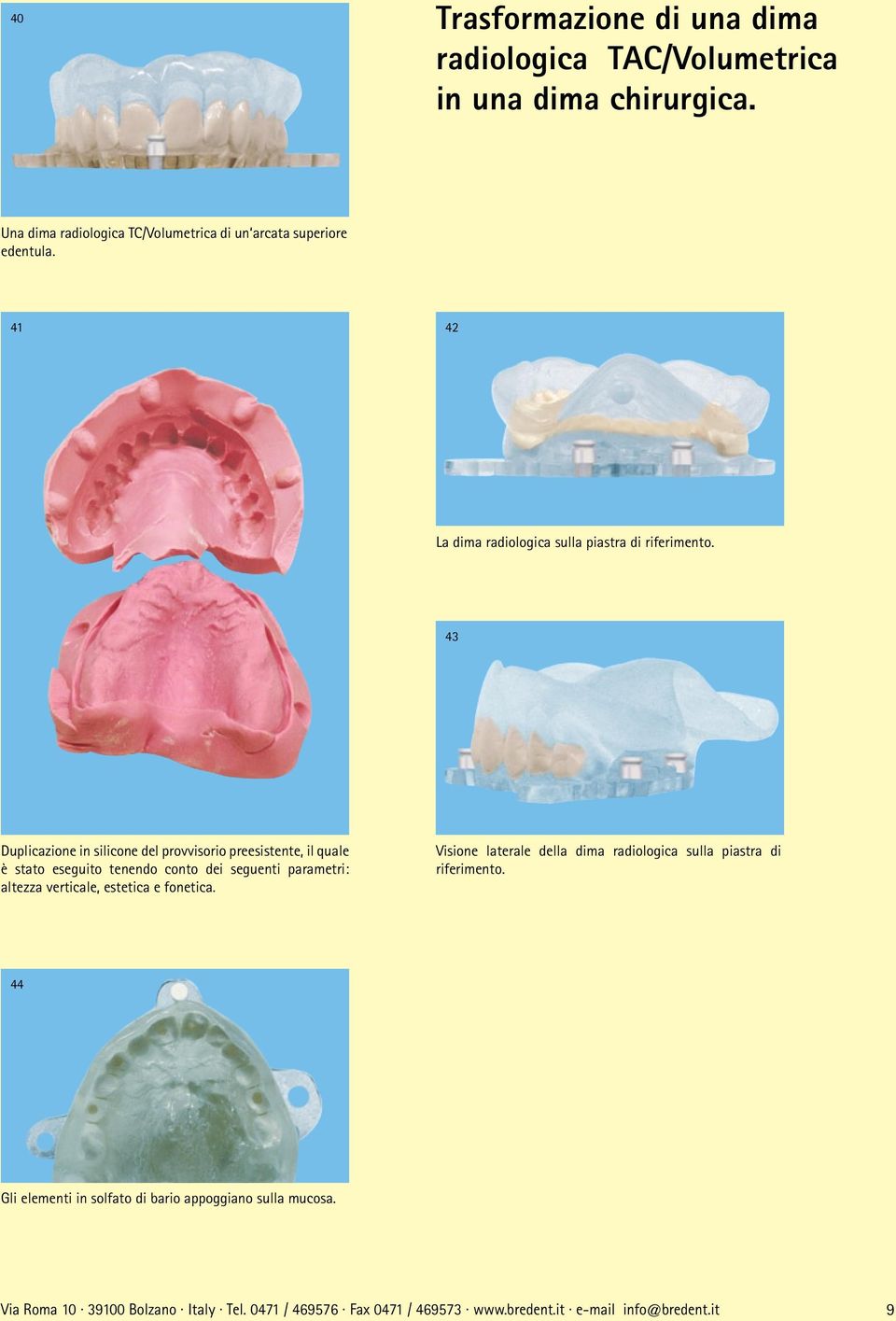 43 Duplicazione in silicone del provvisorio preesistente, il quale è stato eseguito tenendo conto dei seguenti parametri: altezza verticale, estetica e