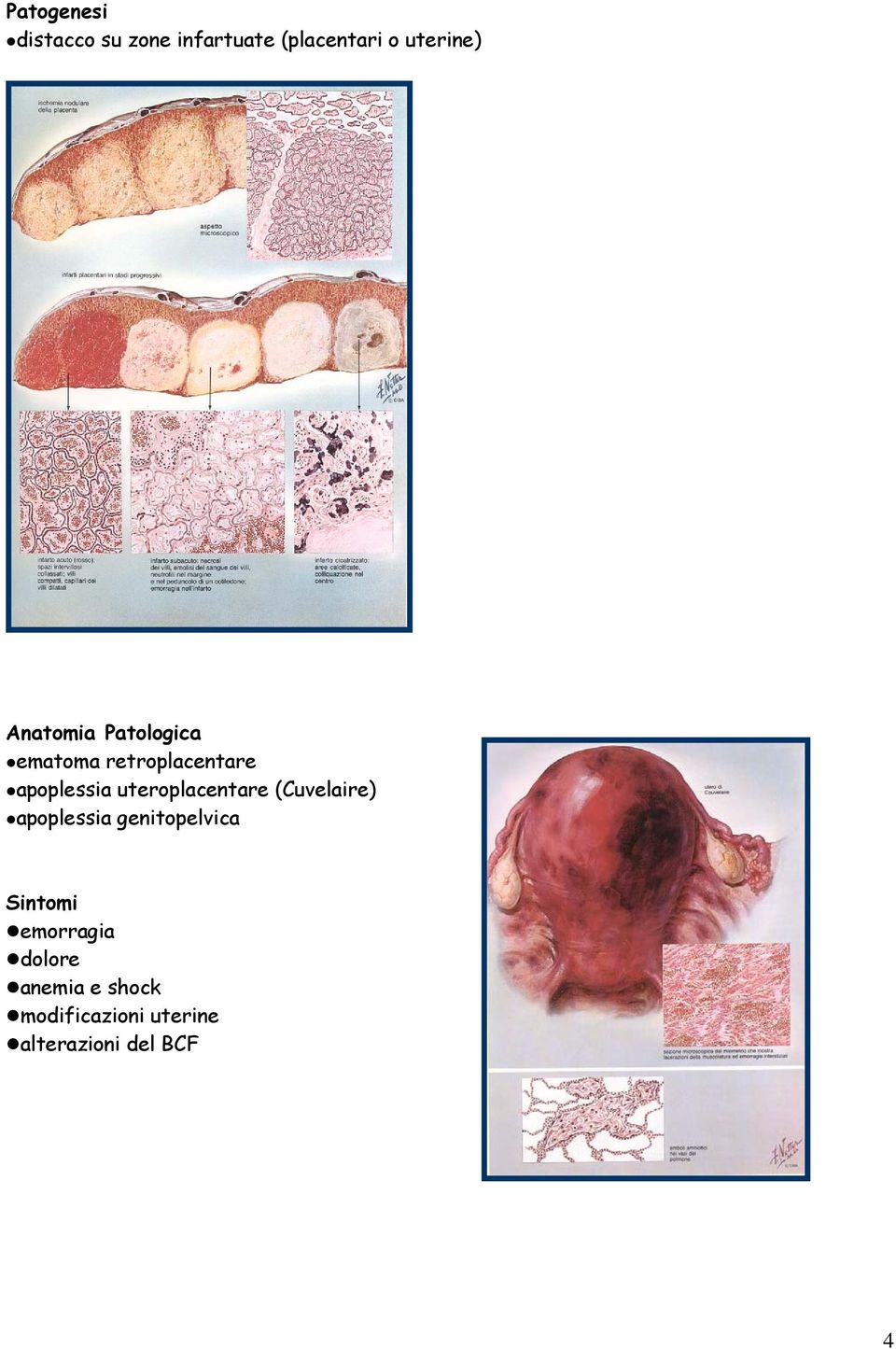 uteroplacentare (Cuvelaire) apoplessia genitopelvica Sintomi