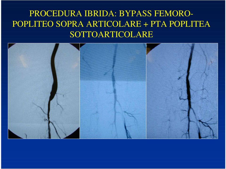 POPLITEO SOPRA