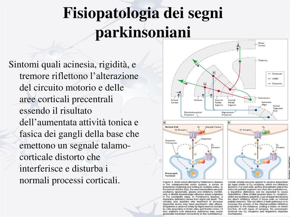 il risultato dell aumentata attività tonica e fasica dei gangli della base che emettono