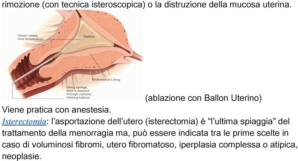 Isterectomia: l asportazione dell utero (isterectomia) è l ultima spiaggia del trattamento