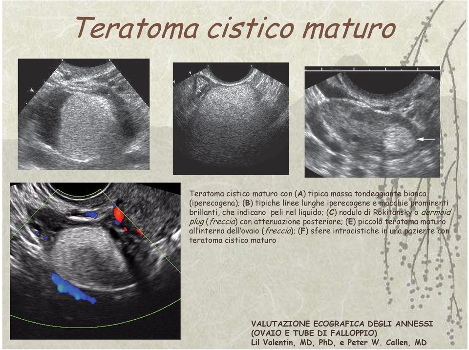 attenuazione posteriore; (E) piccolo teratoma maturo all interno dell ovaio (freccia); (F) sfere intracistiche in una paziente con