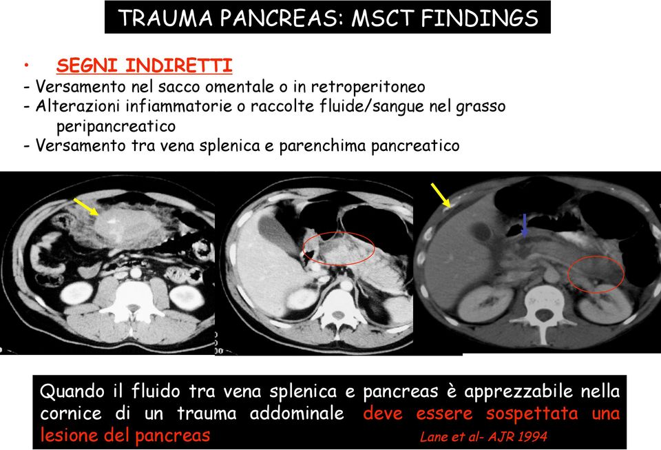 splenica e parenchima pancreatico Quando il fluido tra vena splenica e pancreas è apprezzabile nella