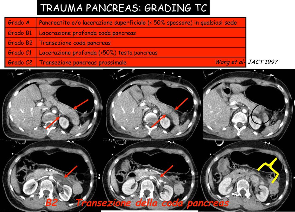 Transezione coda pancreas Grado C1 Lacerazione profonda (>50%) testa pancreas Grado