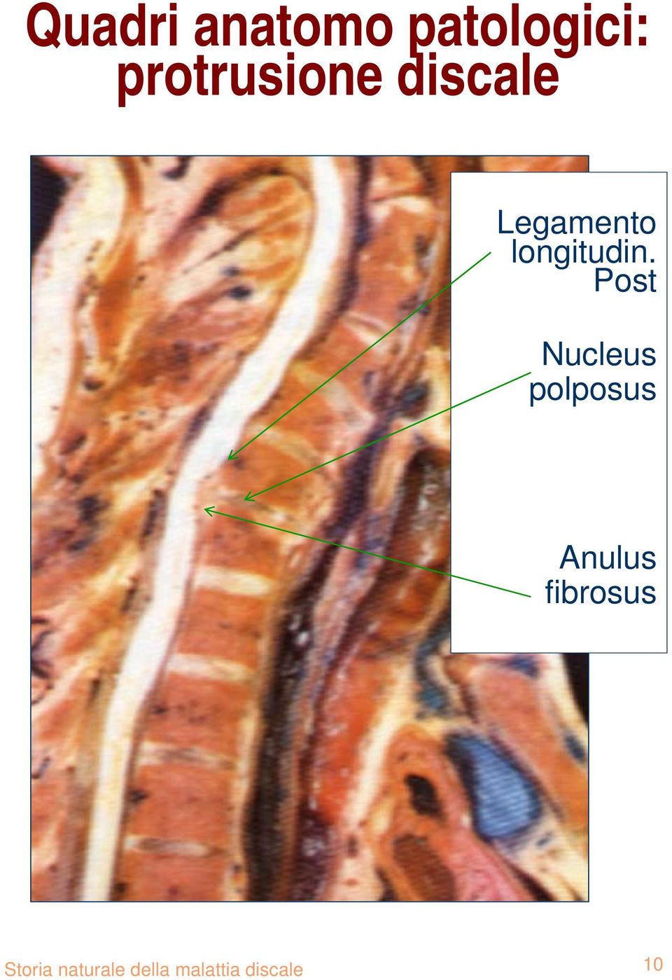 Post Nucleus polposus Anulus