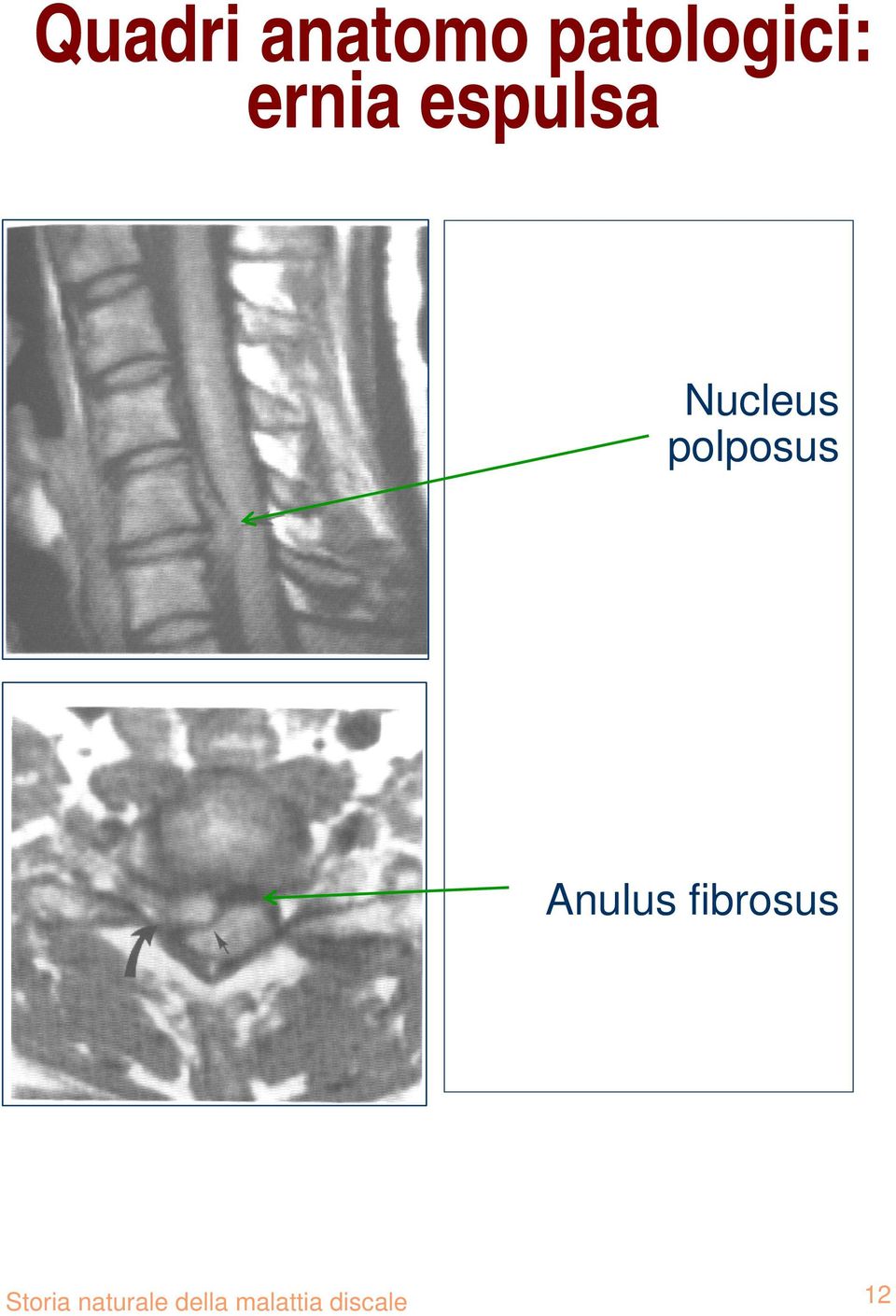 polposus Anulus fibrosus