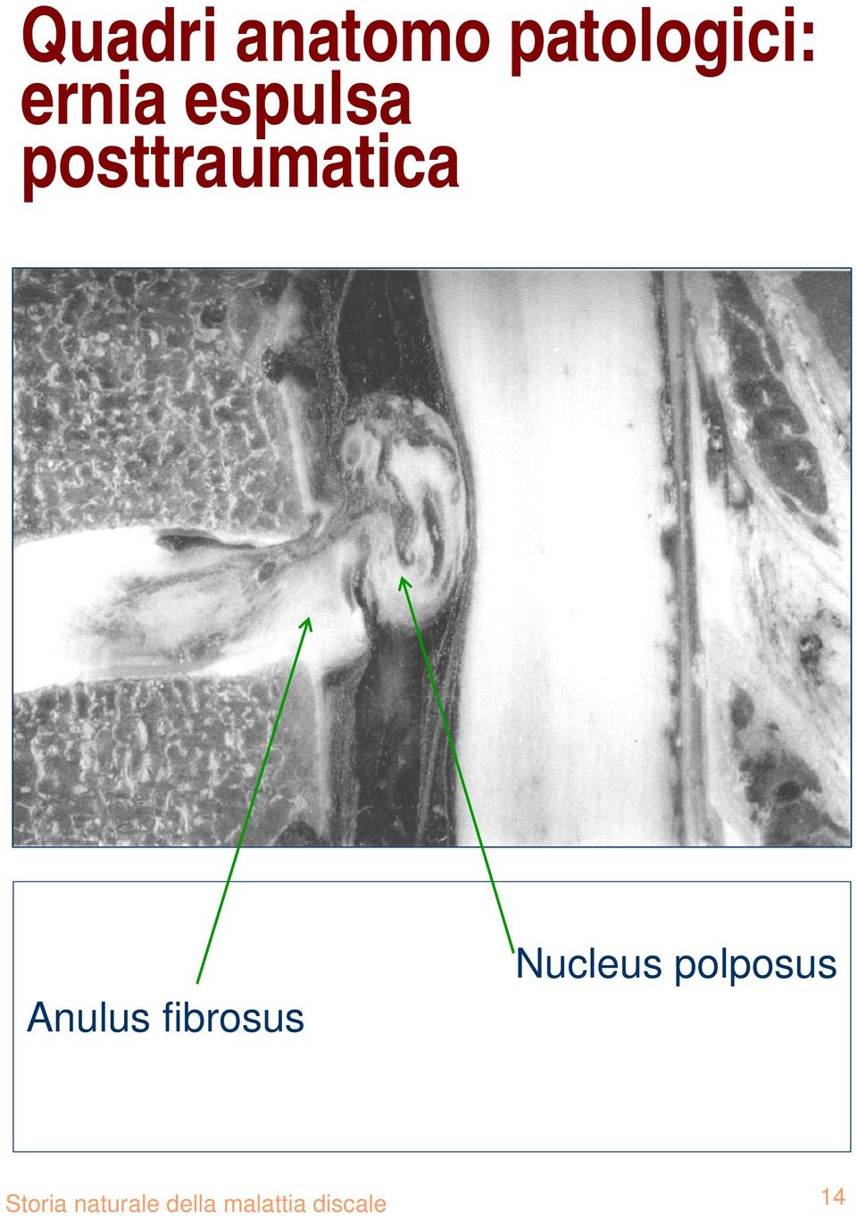 fibrosus Nucleus polposus Storia