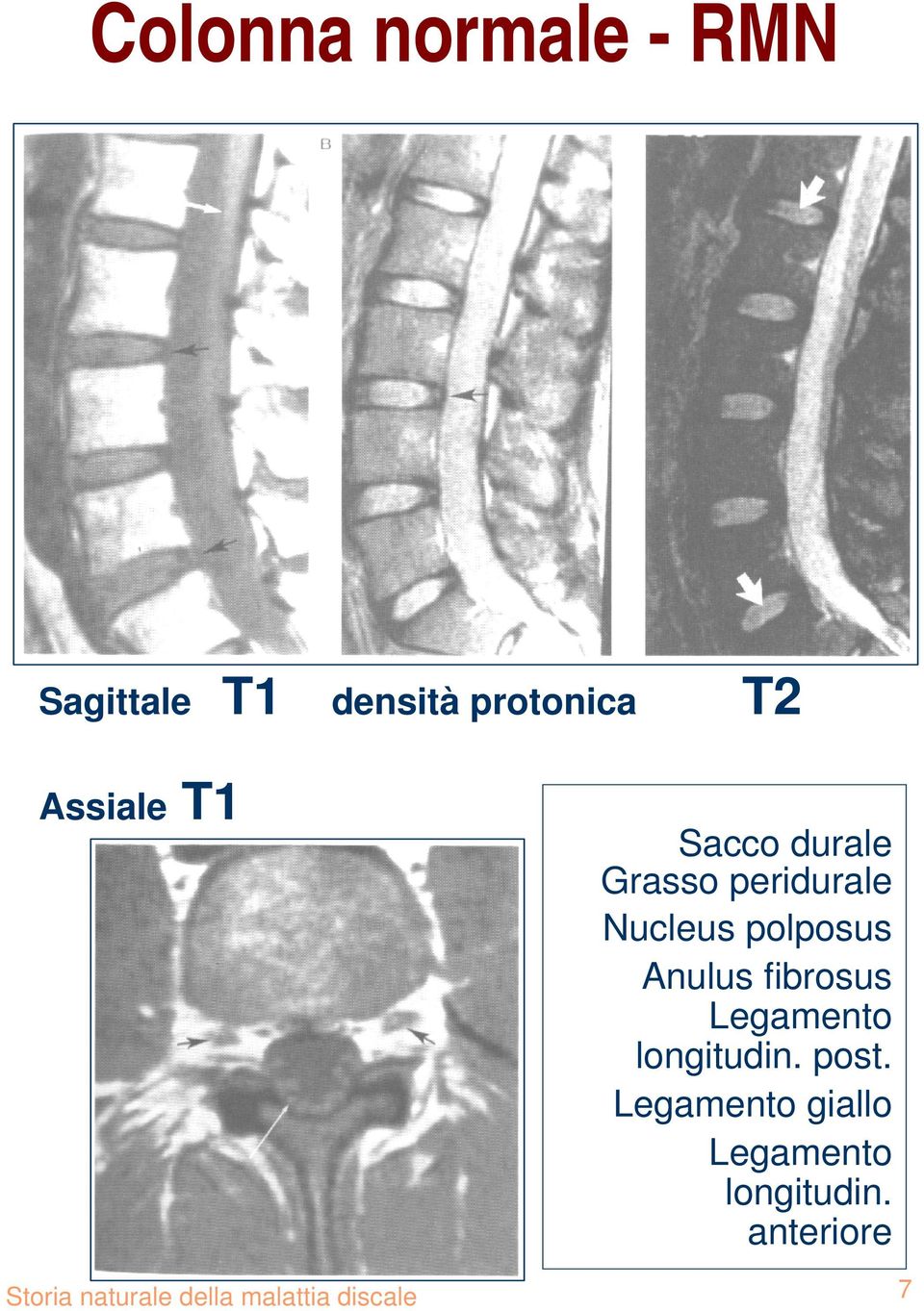 polposus Anulus fibrosus longitudin. post.