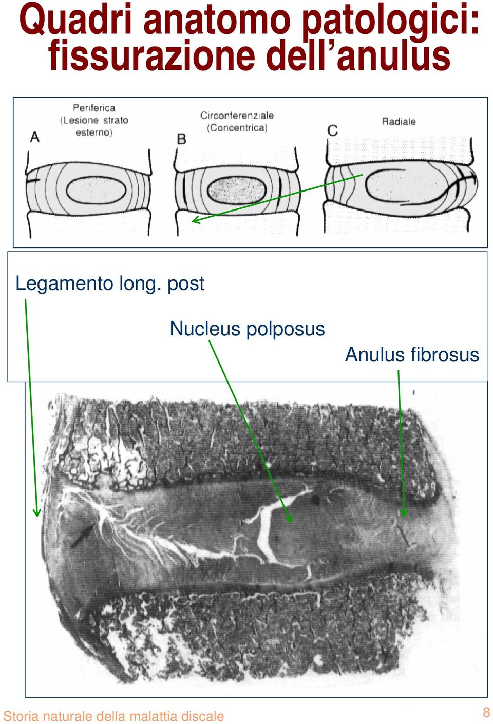 post Nucleus polposus Anulus