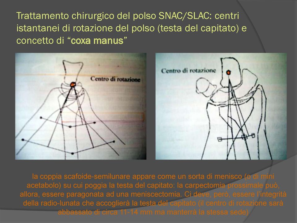 la carpectomia prossimale può, allora, essere paragonata ad una meniscectomia.