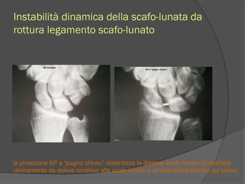 slatentizza la diastasi scafo-lunata (sospettata