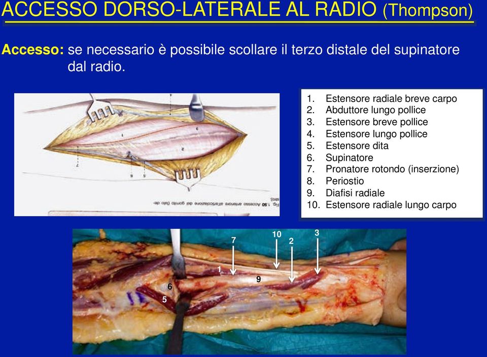 ! Estensore breve pollice 4.! Estensore lungo pollice 5.! Estensore dita 6.! Supinatore 7.
