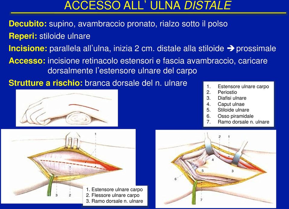 prossimale Accesso: incisione retinacolo estensori e fascia avambraccio, caricare dorsalmente l estensore ulnare del carpo Strutture a