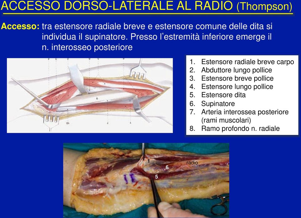 ! Estensore radiale breve carpo 2.! Abduttore lungo pollice 3.! Estensore breve pollice 4.