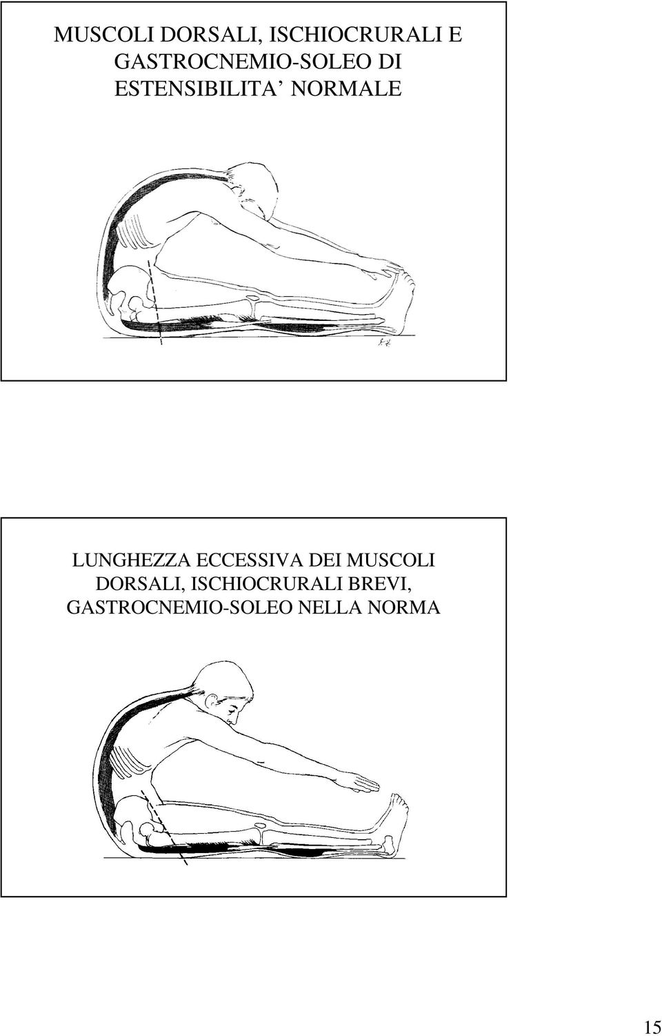 NORMALE LUNGHEZZA ECCESSIVA DEI MUSCOLI