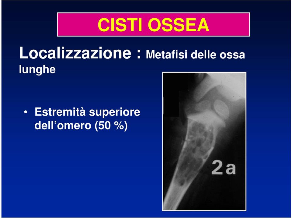 Metafisi delle ossa