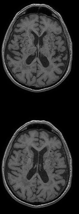 MRI: atrofia temporo-mesiale, temporale laterale e parietale,