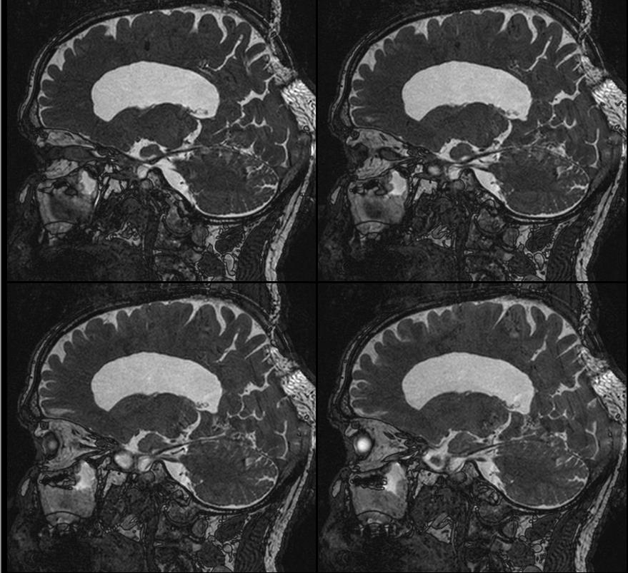 MRI con studio del flusso liquorale: velocità di flusso nei