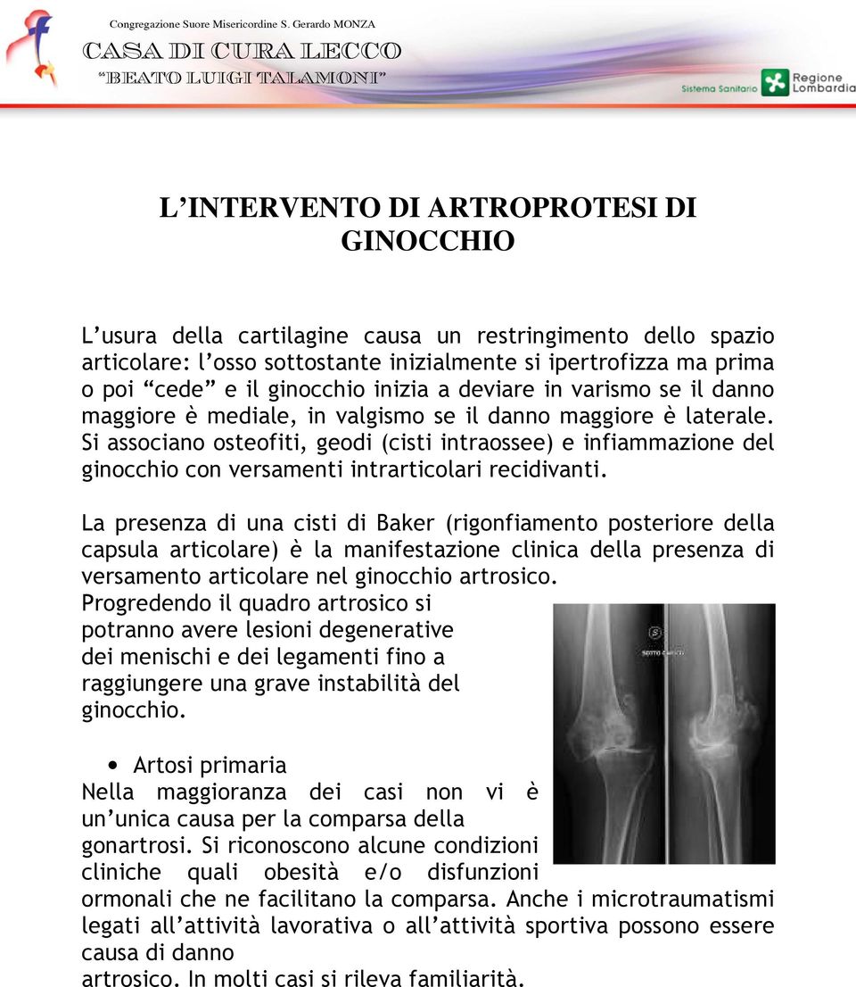 Si associano osteofiti, geodi (cisti intraossee) e infiammazione del ginocchio con versamenti intrarticolari recidivanti.