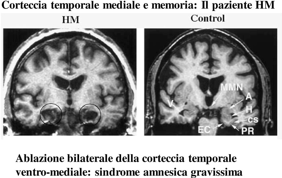 bilaterale della corteccia temporale