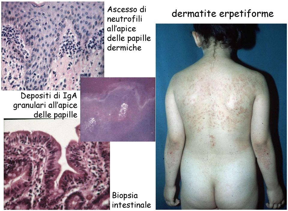 erpetiforme Depositi di IgA