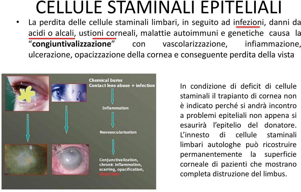 condizione di deficit di cellule staminali il trapianto di cornea non è indicato perché si andrà incontro a problemi epiteliali non appena si esaurirà l epitelio