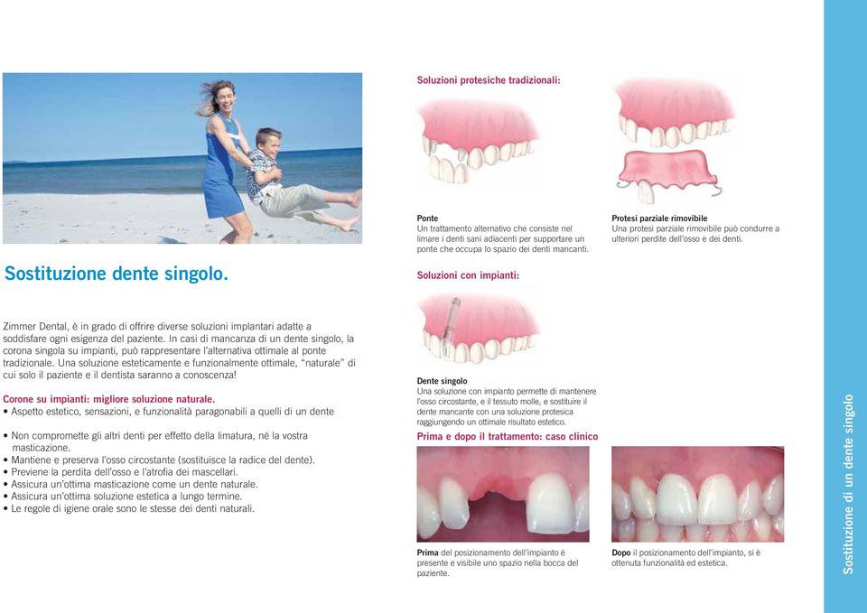 Soluzioni con impianti: Zimmer Dental, è in grado di offrire diverse soluzioni implantari adatte a soddisfare ogni esigenza del paziente.