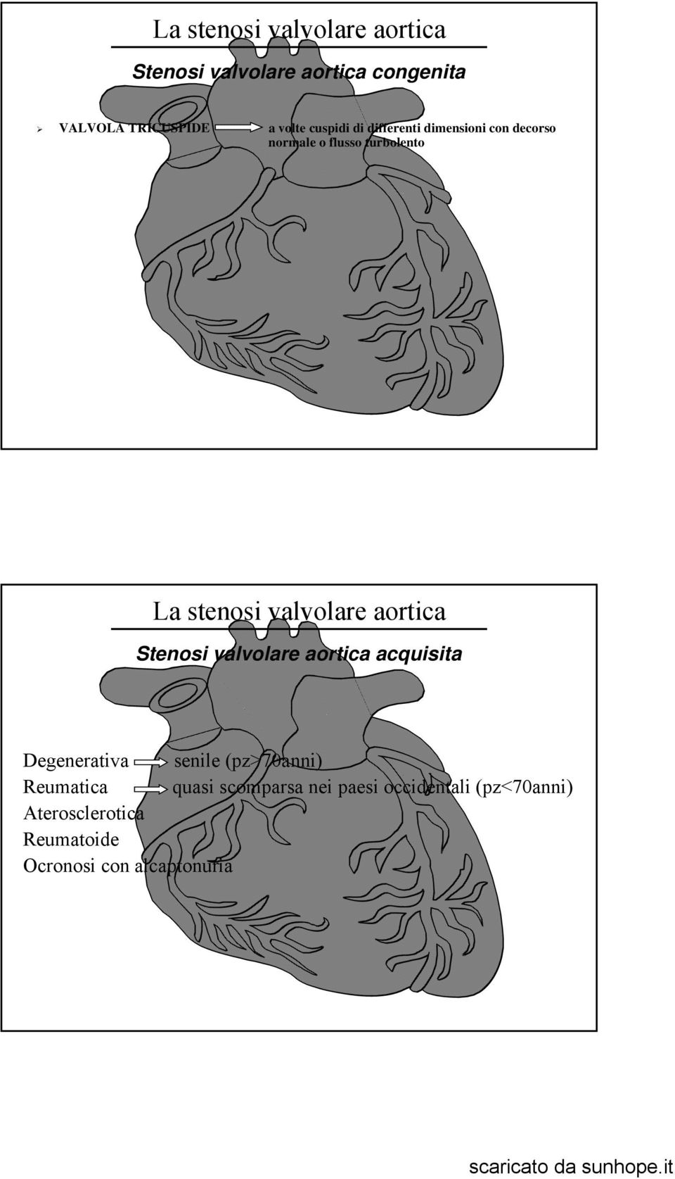 valvolare aortica acquisita Degenerativa senile (pz>70anni) Reumatica quasi
