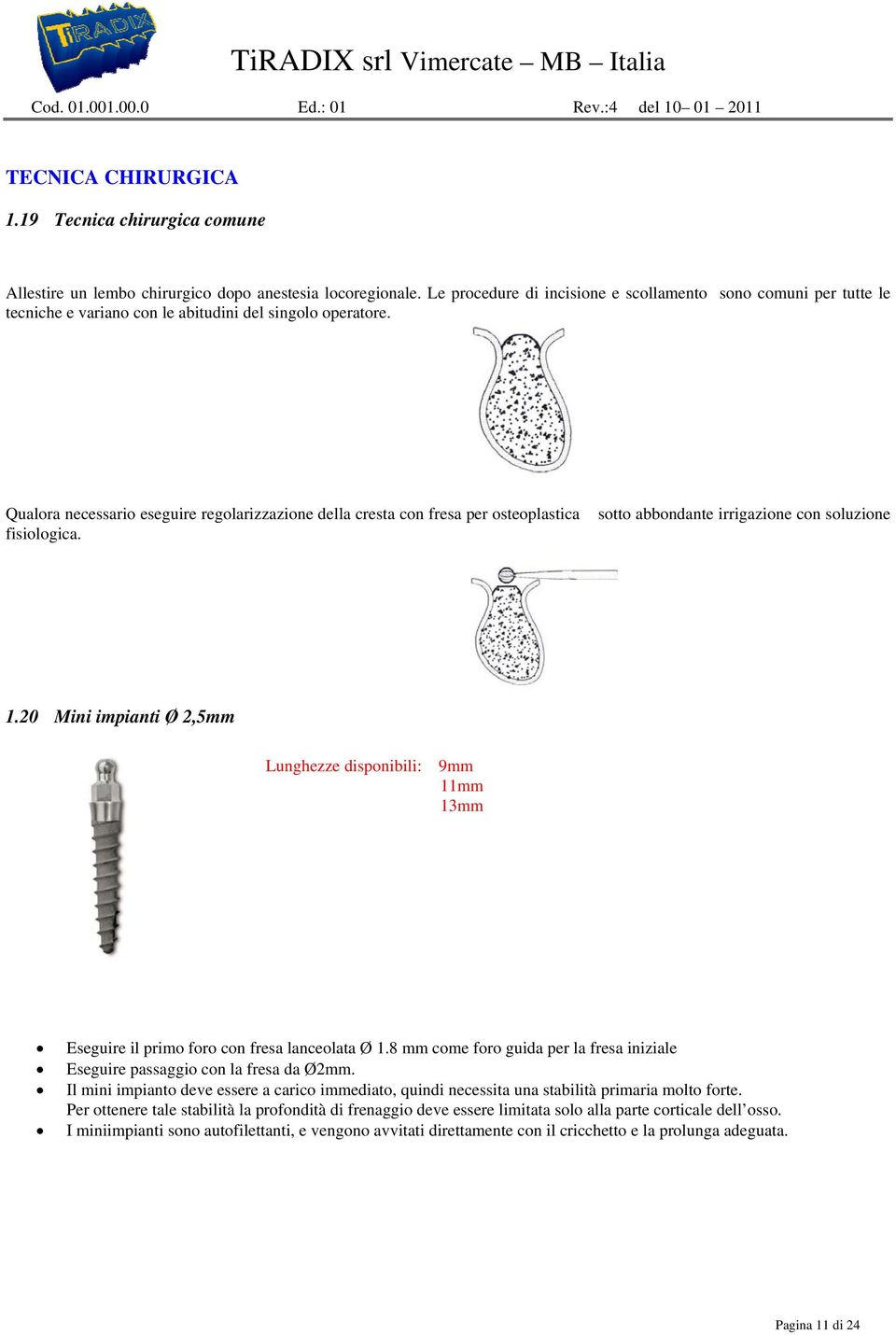 Qualora necessario eseguire regolarizzazione della cresta con fresa per osteoplastica fisiologica. sotto abbondante irrigazione con soluzione 1.