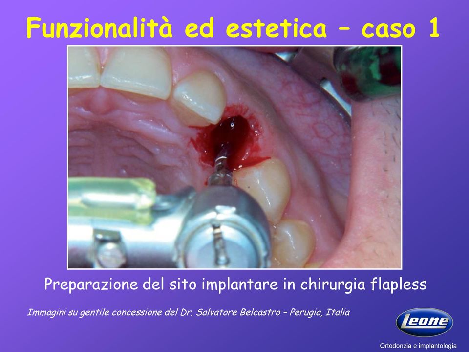 chirurgia flapless Immagini su gentile